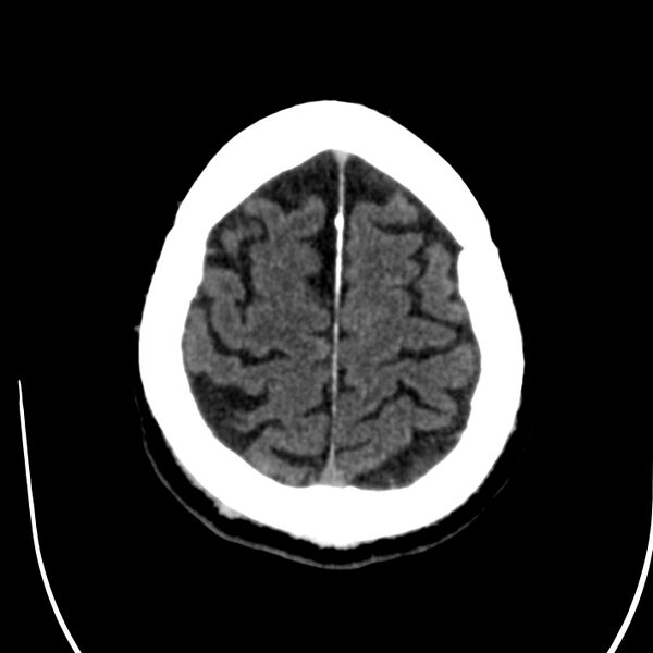 File:Brain Pantopaque remnants (Radiopaedia 78403-91048 Axial non-contrast 76).jpg