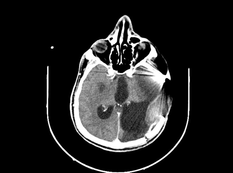 File:Brain injury by firearm projectile (Radiopaedia 82068-96088 B 120).jpg