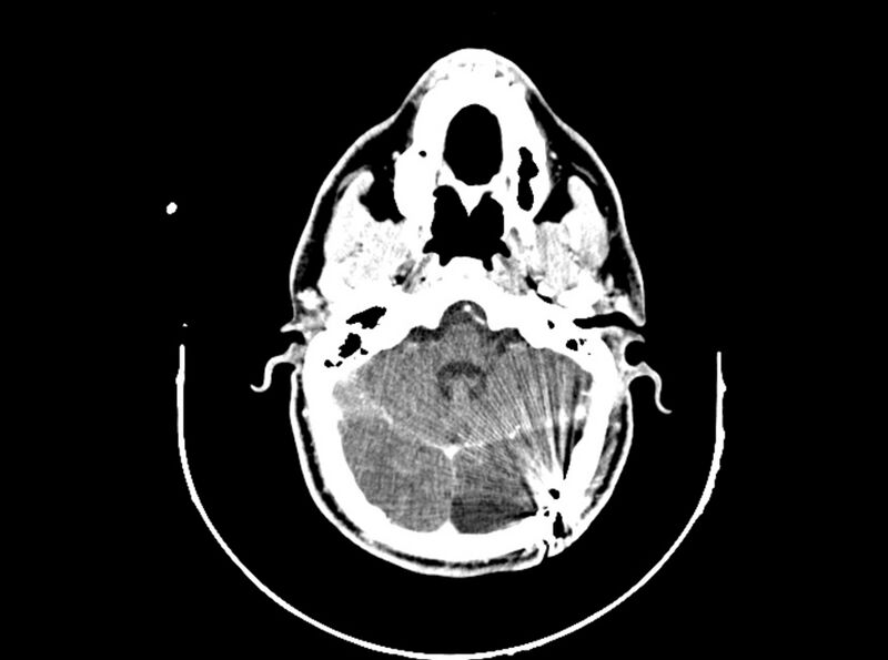 File:Brain injury by firearm projectile (Radiopaedia 82068-96088 B 85).jpg