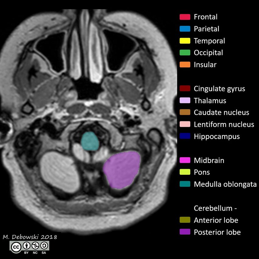 Brain lobes - annotated MRI (Radiopaedia 61691-69700 Axial 73).JPG