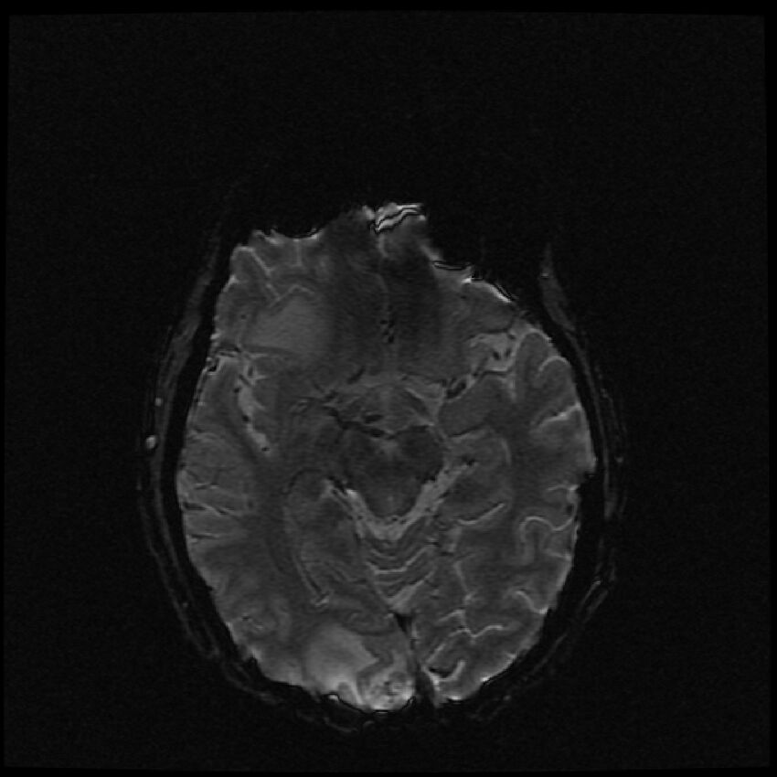 Brain metastases (renal cell carcinoma) (Radiopaedia 42571-45704 Axial SWI 37).jpg