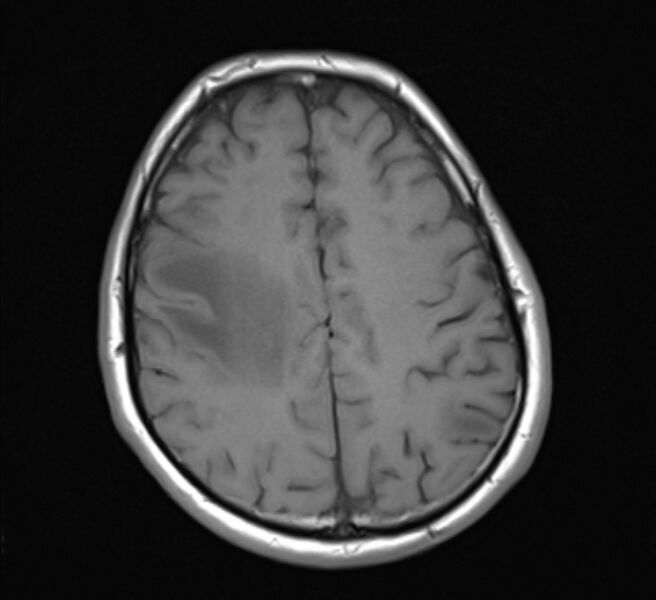 File:Brain metastases - lung cancer primary (Radiopaedia 75060-86115 Axial T1 18).jpg