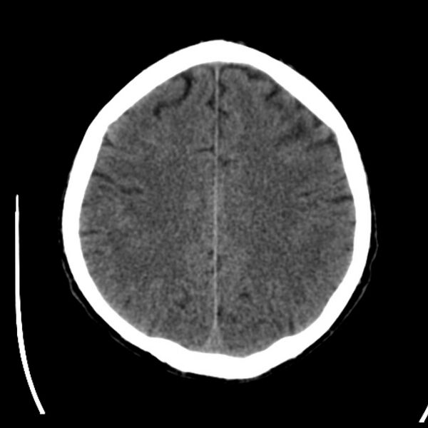 File:Brain metastases from lung cancer (Radiopaedia 24480-24781 Axial non-contrast 35).jpg