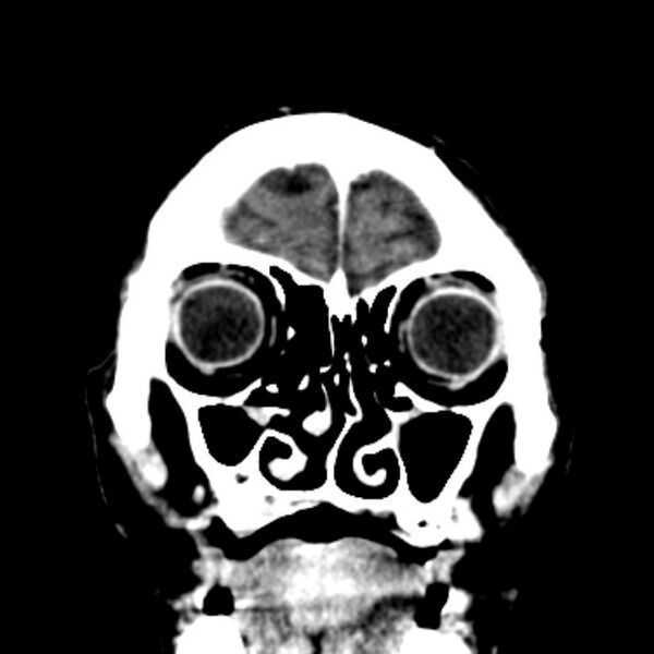 File:Brain metastases from lung cancer (Radiopaedia 27849-28092 Coronal C+ delayed 9).jpg