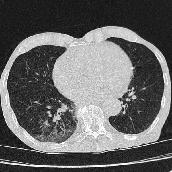 File:Brain metastases from lung cancer (Radiopaedia 27849-28093 Axial lung window 44).jpg