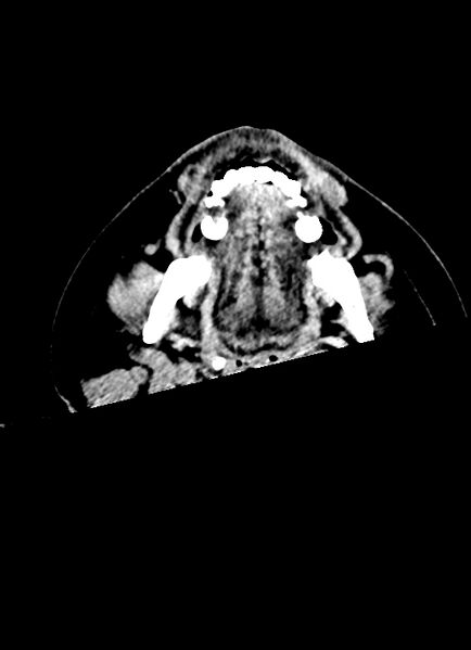 File:Brainstem hemorrhage (Radiopaedia 81294-94976 Axial non-contrast 80).jpg