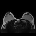 Breast implants - MRI (Radiopaedia 26864-27035 Axial T2 24).jpg