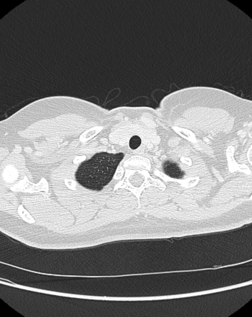 Bronchial atresia (Radiopaedia 50007-55297 Axial lung window 4).jpg