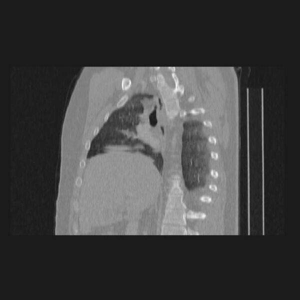 File:Bronchial atresia (Radiopaedia 60685-68439 Sagittal lung window 38).jpg