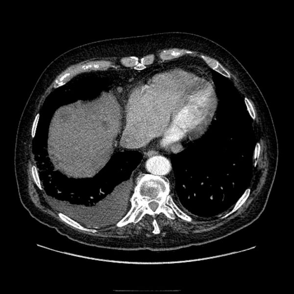 File:Bronchogenic adenocarcinoma and pulmonary embolism (Radiopaedia 9097-9806 D 45).jpg