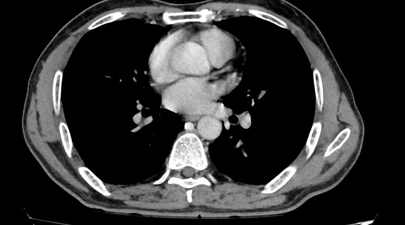File:Bronchogenic carcinoma with superior vena cava syndrome (Radiopaedia 36497-38054 Axial C+ delayed 57).jpg