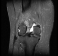 Bucket handle tear - medial meniscus (Radiopaedia 24900-25163 Coronal T2 fat sat 2).png