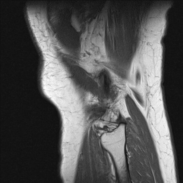 File:Bucket handle tear - medial meniscus (Radiopaedia 79028-91942 Sagittal T1 1).jpg