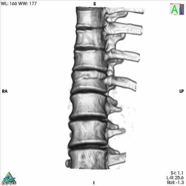 File:Bulging of paraspinal line in traumatic thoracal spinal compression fracture (Radiopaedia 29221-35872 3D VR 14).jpg
