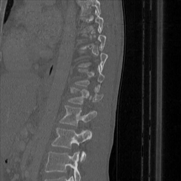 File:Bulging of paraspinal line in traumatic thoracal spinal compression fracture (Radiopaedia 29221-35872 Sagittal bone window 42).jpg