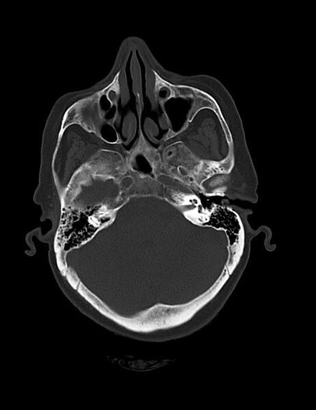 File:Burnt-out meningioma (Radiopaedia 51557-57337 Axial bone window 11).jpg