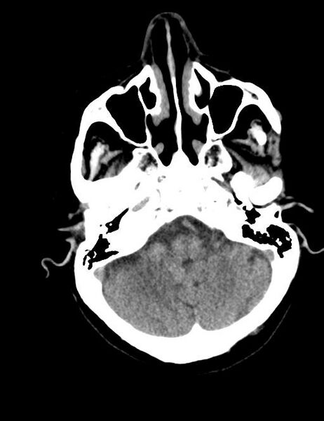File:Burnt-out meningioma (Radiopaedia 51557-57337 Axial non-contrast 6).jpg