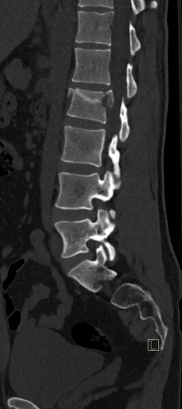 File:Calcaneal fractures with associated L2 burst fracture (Radiopaedia 71671-82493 Sagittal bone window 29).jpg