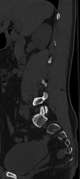 File:Calcaneal fractures with associated L2 burst fracture (Radiopaedia 71671-82493 Sagittal bone window 62).jpg