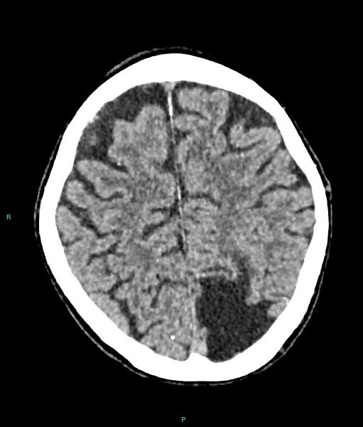 File:Calcified cerebral emboli from left ventricular thrombus (Radiopaedia 84420-99758 Axial non-contrast 27).jpg