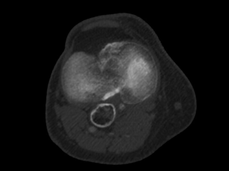File:Calcified hematoma - popliteal fossa (Radiopaedia 63938-72763 C 32).jpg
