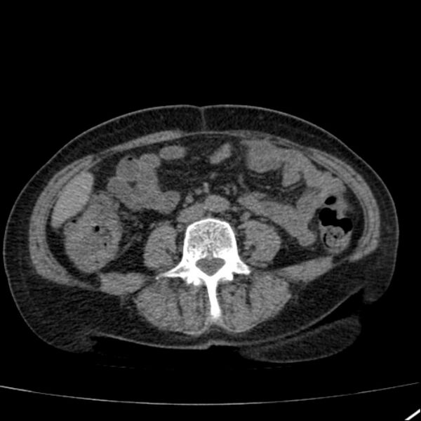 File:Calcified hepatic hydatid cyst (Radiopaedia 26872-27046 Axial non-contrast 51).jpg