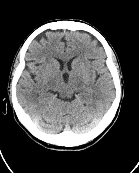 File:Calcified meningioma (Radiopaedia 74361-85243 Axial non-contrast 30).jpg