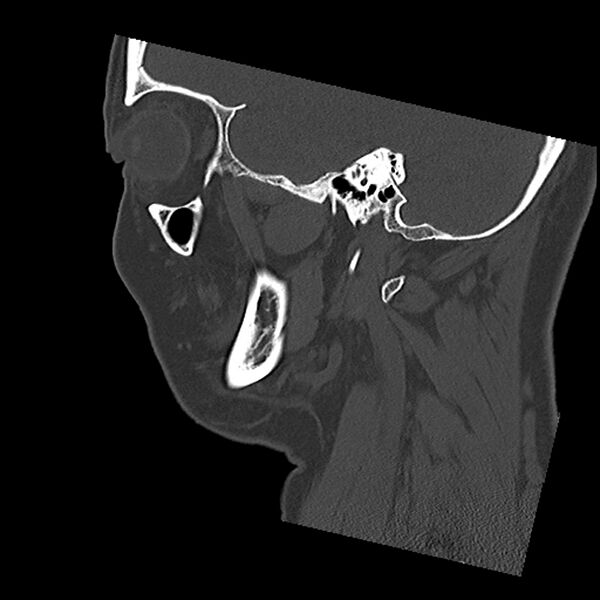 File:Canal up mastoidectomy (Radiopaedia 78108-90638 Sagittal bone window 17).jpg