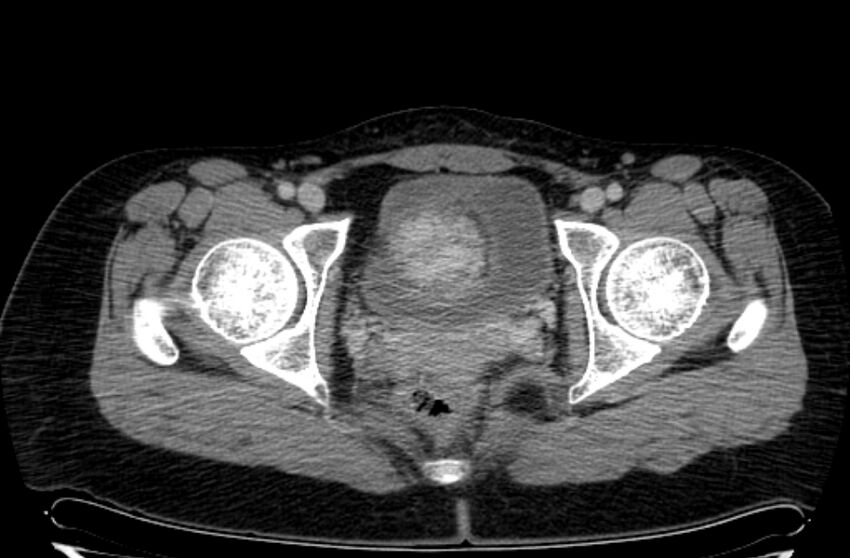 Cannonball metastases - uterine choriocarcinoma (Radiopaedia 70137-80174 A 49).jpg