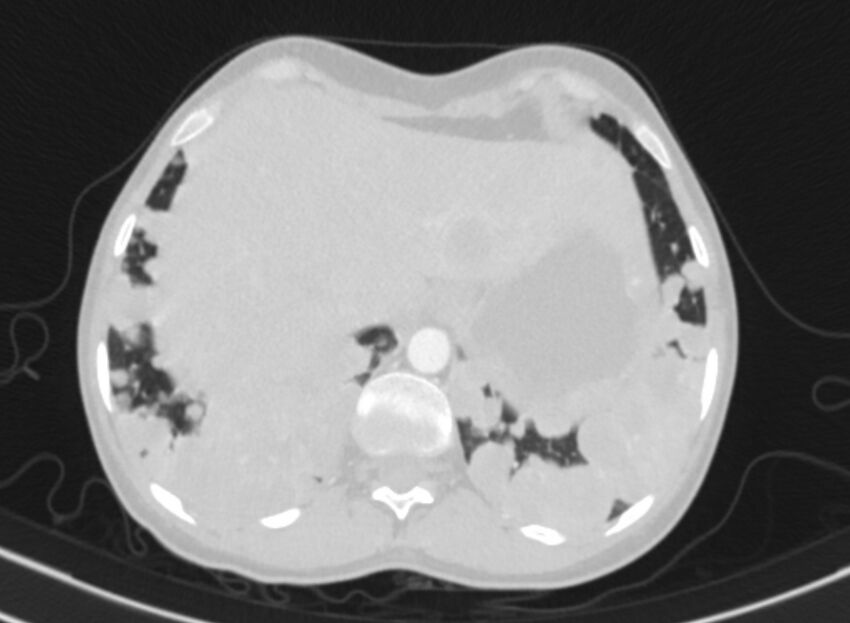 Cannonball metastases from breast cancer (Radiopaedia 91024-108569 Axial lung window 91).jpg