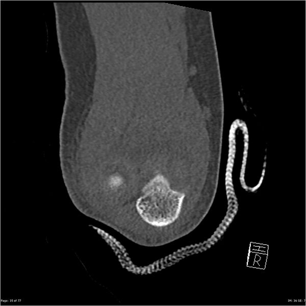 File:Capitellum fracture (Radiopaedia 23352-23426 Coronal bone window 35).jpg