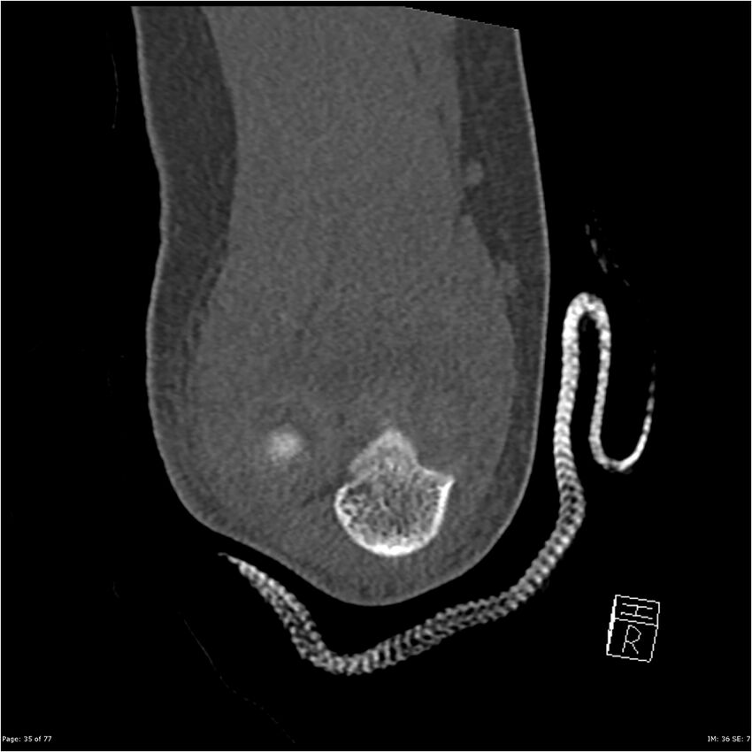 Capitellum fracture (Radiopaedia 23352-23426 Coronal bone window 35).jpg