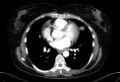 Cardiac sarcoidosis (Radiopaedia 74548-85534 A 48).jpg