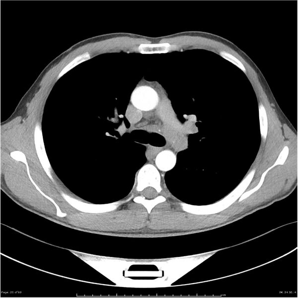File:Cavitating lung cancer (Radiopaedia 25796-25945 C+ arterial phase 21).jpg