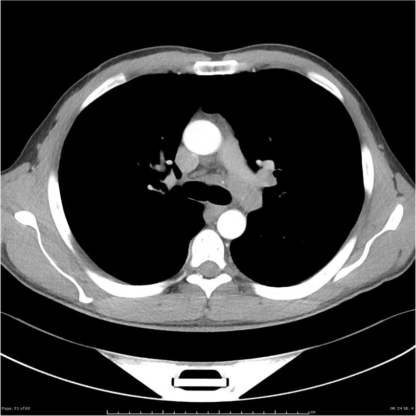 Cavitating lung cancer (Radiopaedia 25796-25945 C+ arterial phase 21).jpg