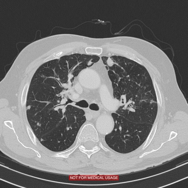 File:Cavitating pulmonary metastases (Radiopaedia 24920-25184 Axial lung window 8).jpg