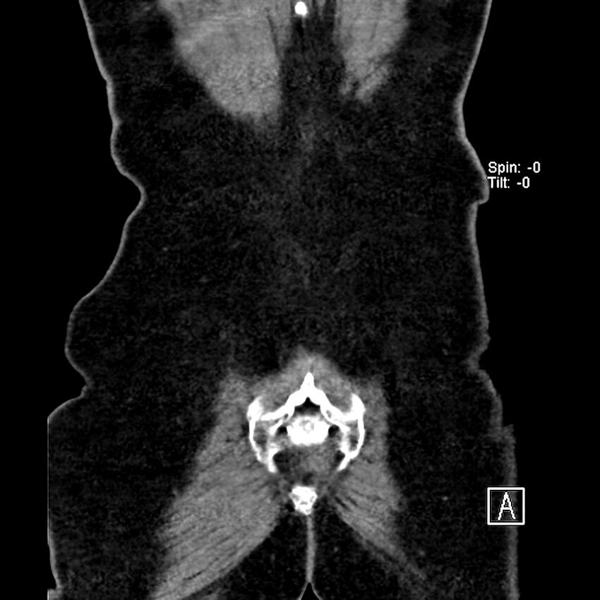 Cecal volvulus (Radiopaedia 90897-108397 Coronal non-contrast 4).jpg