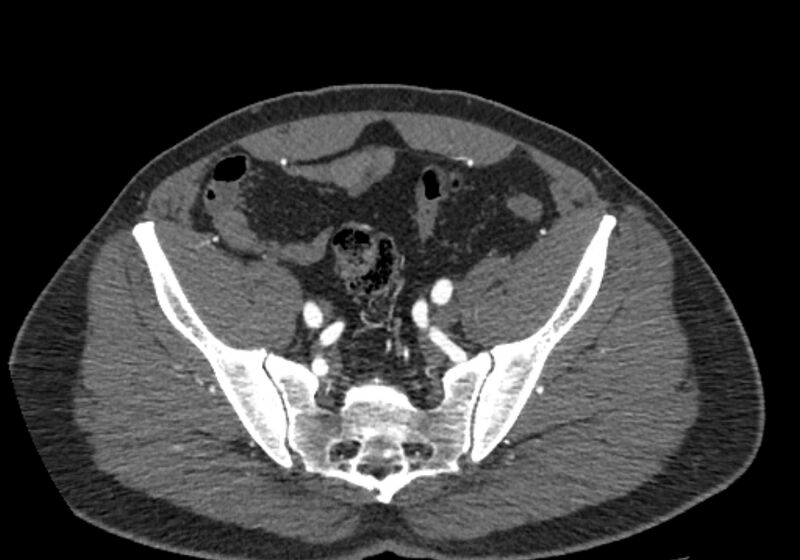File:Celiac artery dissection (Radiopaedia 52194-58080 A 95).jpg