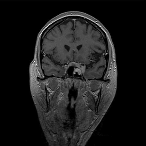 File:Central base of skull meningioma (Radiopaedia 53531-59549 Coronal T1 C+ 5).jpg