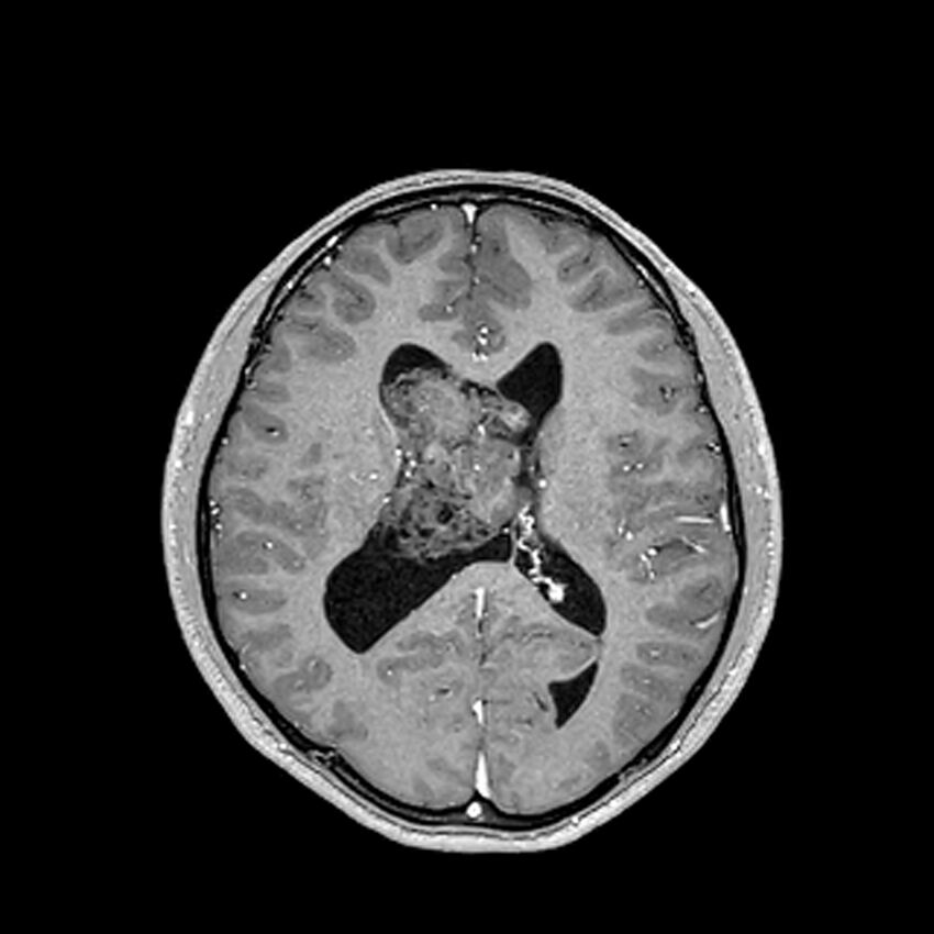 Central neurocytoma (Radiopaedia 79320-92380 Axial T1 C+ 144).jpg