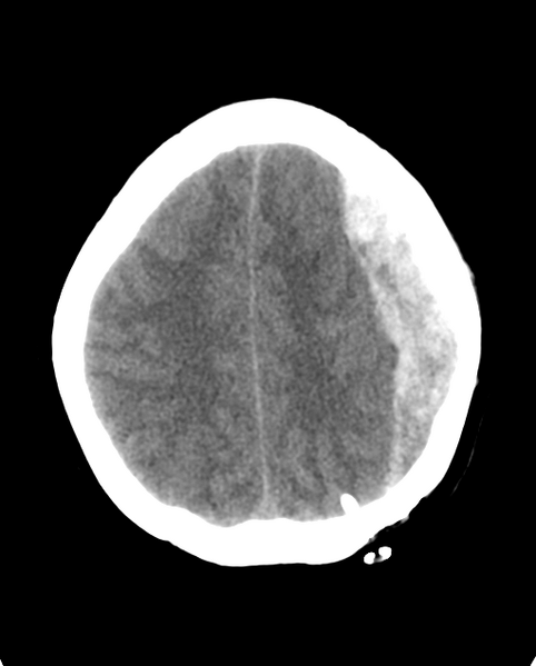 File:Cerebellar ependymoma complicated by post-operative subdural hematoma (Radiopaedia 83322-97737 Axial non-contrast 8).png