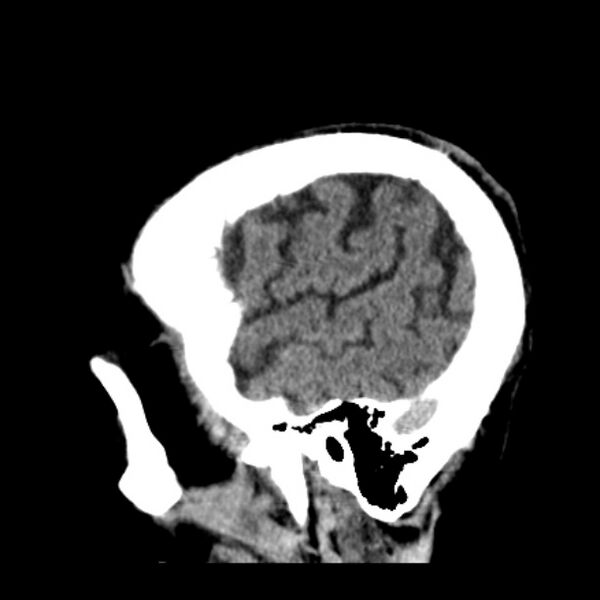 File:Cerebellar hemorrhage (Radiopaedia 27193-27359 C 39).jpg