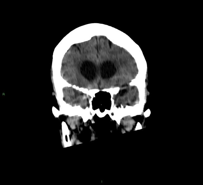 File:Cerebellar hemorrhage (Radiopaedia 58792-66026 Coronal non-contrast 44).jpg