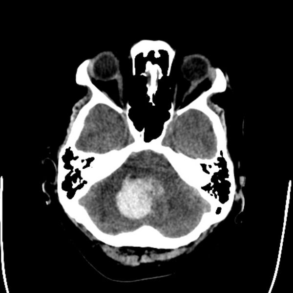 File:Cerebellar hemorrhage causing obstructive hydrocephalus (Radiopaedia 33989-35207 Axial non-contrast 11).jpg