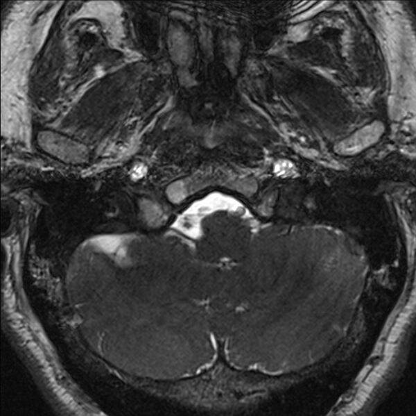File:Cerebellopontine angle meningioma (Radiopaedia 24459-24764 I 10).jpg