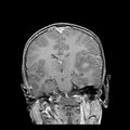 Cerebral abscess post cardiac surgery (Radiopaedia 27244-27420 Coronal T1 C+ 12).jpg