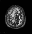 Cerebral abscesses secondary to contusions (Radiopaedia 5201-6968 Axial T2 11).jpg