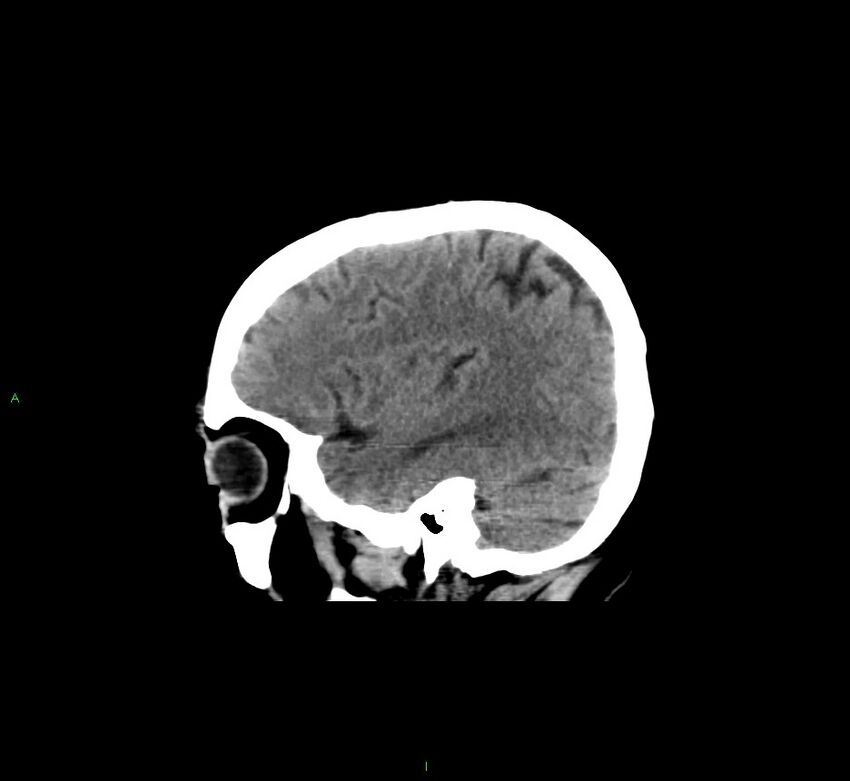 Cerebral amyloid angiopathy-associated lobar intracerebral hemorrhage (Radiopaedia 58529-65681 B 13).jpg