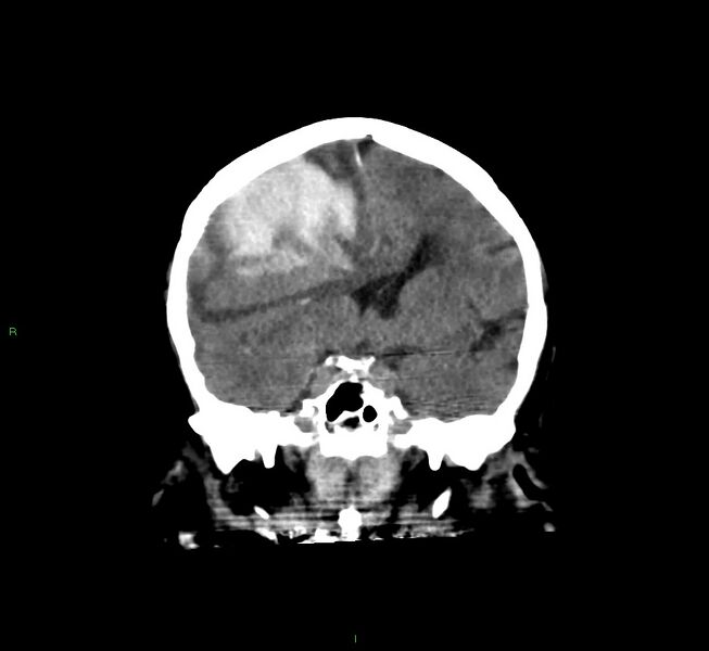 File:Cerebral amyloid angiopathy-associated lobar intracerebral hemorrhage (Radiopaedia 58560-65723 Coronal non-contrast 42).jpg