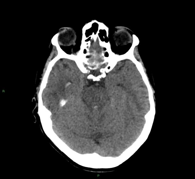 File:Cerebral amyloid angiopathy-associated lobar intracerebral hemorrhage (Radiopaedia 58566-65730 Axial non-contrast 34).jpg